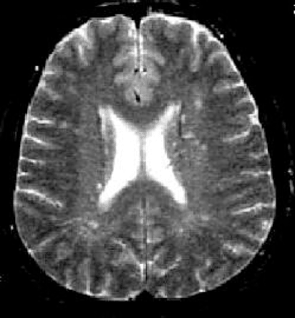 Image: Brain MRI showing periventricular white matter lesions (photo courtesy University of Barcelona, Spain).